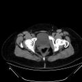 Bilateral ovarian mature cystic teratomas (Radiopaedia 79373-92457 Axial non-contrast 87).jpg