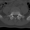 Bilateral pars defect (Radiopaedia 26691-26846 Axial bone window 48).jpg
