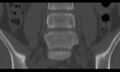 Bilateral pars defect (Radiopaedia 26691-26846 Coronal bone window 18).jpg