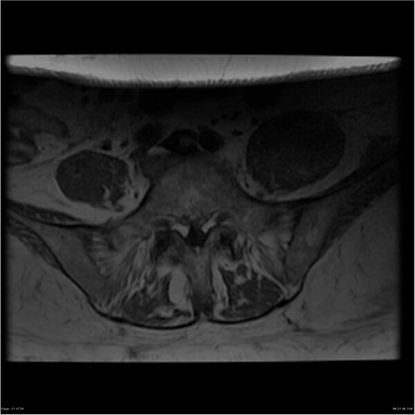 File:Bilateral psoas hematomas (Radiopaedia 24057-24280 T1 17).jpg
