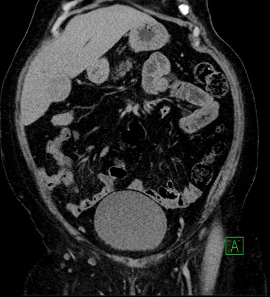 File:Bilateral sporadic synchronous clear cell renal cell carcinoma (Radiopaedia 85035-100575 I 10).jpg