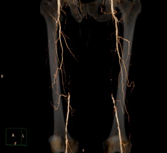 File:Bilateral superficial femoral arterial occlusion (Radiopaedia 25682-25857 3D VR 20).jpg