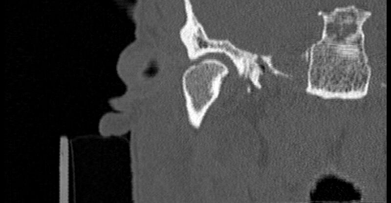 File:Bilateral temporal bone fractures (Radiopaedia 29482-29970 Coronal 83).jpg