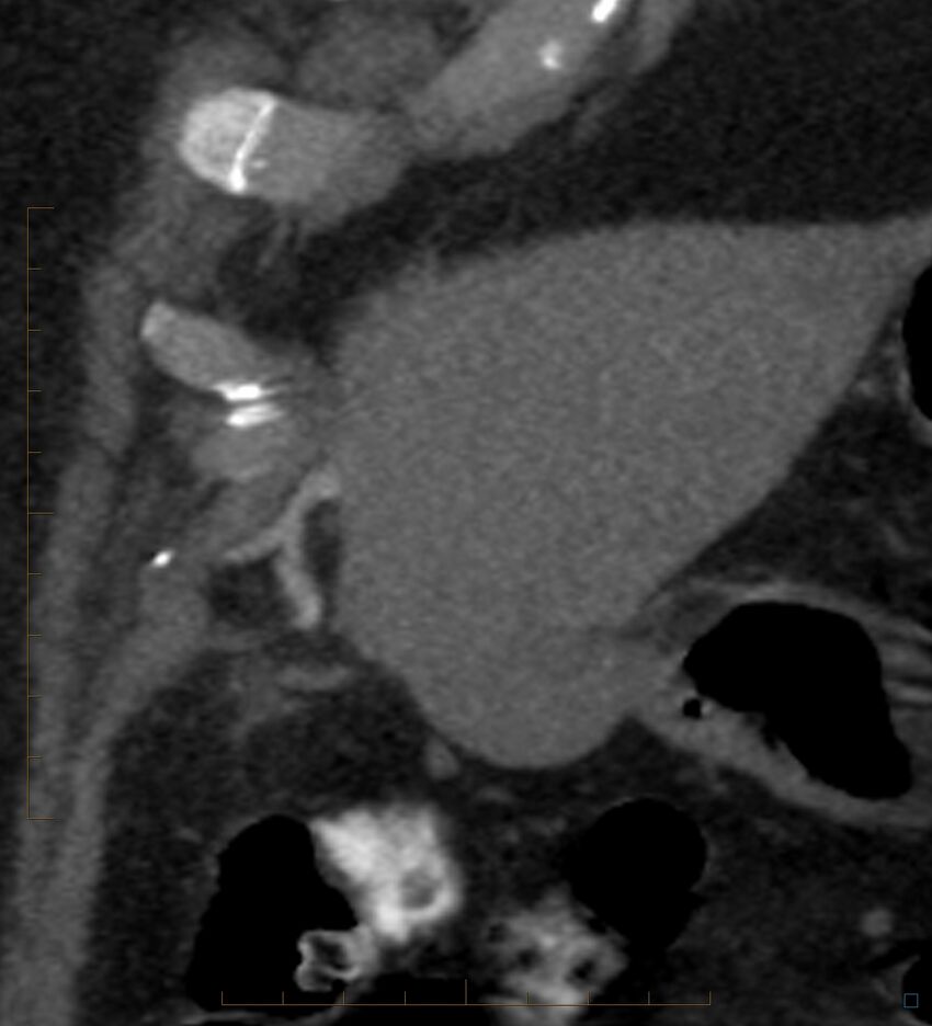 Bile leak from accessory duct(s) of Luschka post cholecystectomy (Radiopaedia 40736-43389 B 11).jpg