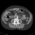 Biliary necrosis - liver transplant (Radiopaedia 21876-21845 A 33).jpg