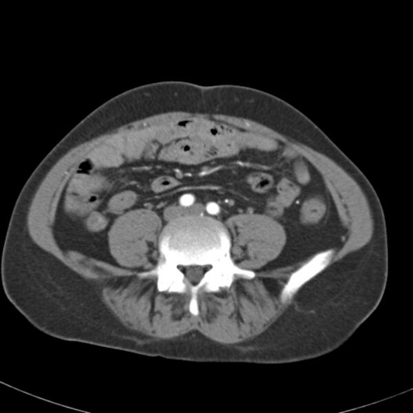 File:Biliary necrosis - liver transplant (Radiopaedia 21876-21845 A 44).jpg