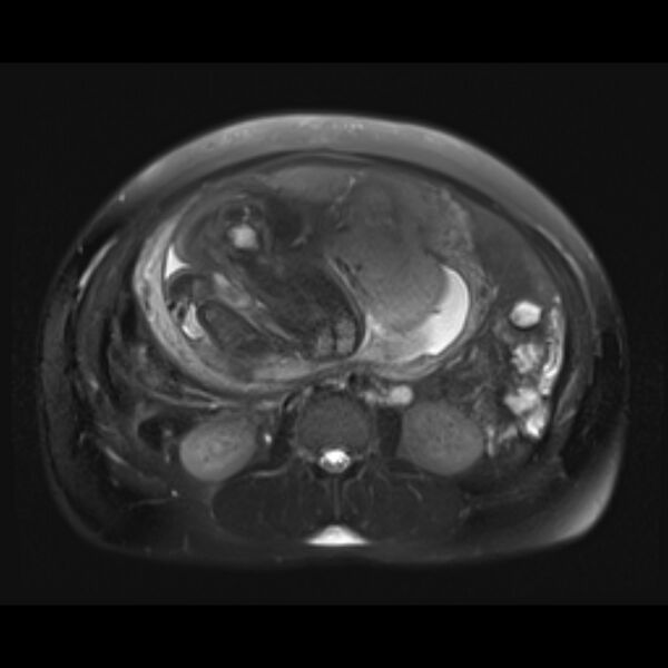 File:Bilobed placenta accreta (Radiopaedia 69648-79591 Axial T2 fat sat 15).jpg
