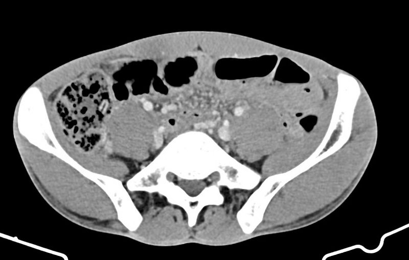 File:Blunt injury to the small bowel (Radiopaedia 74953-85987 A 136).jpg
