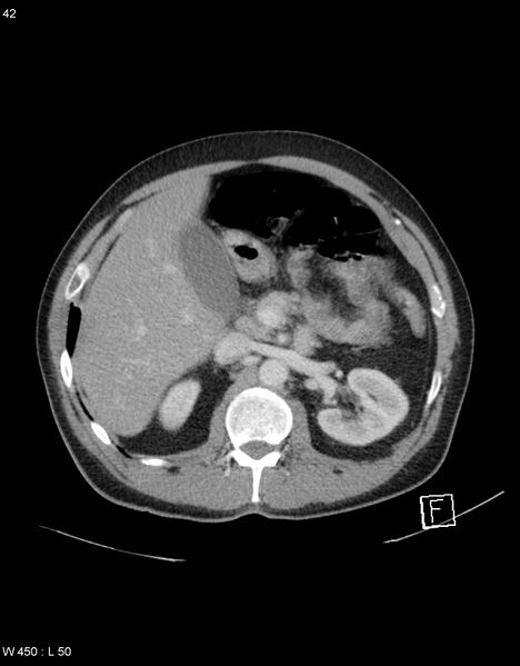 File:Boerhaave syndrome with tension pneumothorax (Radiopaedia 56794-63603 A 21).jpg