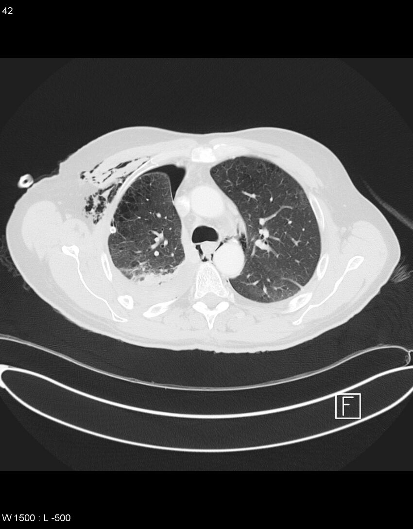 Boerhaave syndrome with tension pneumothorax (Radiopaedia 56794-63605 Axial lung window 20).jpg