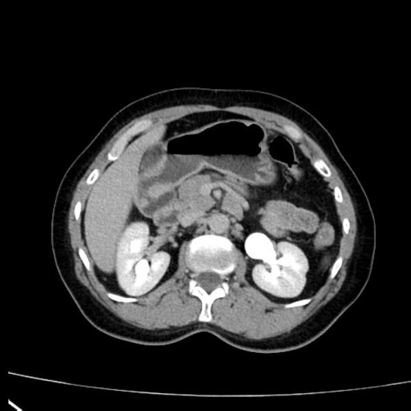 File:Bosniak renal cyst - type I (Radiopaedia 27479-27675 D 14).jpg