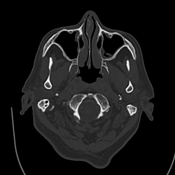 File:Brain Pantopaque remnants (Radiopaedia 78403-91048 Axial bone window 13).jpg