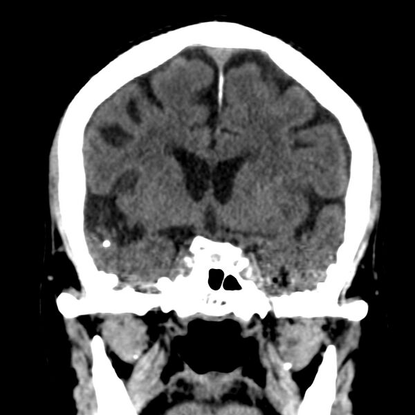File:Brain Pantopaque remnants (Radiopaedia 78403-91048 Coronal non-contrast 31).jpg