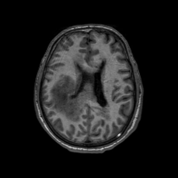 File:Brain abscess complicated by intraventricular rupture and ventriculitis (Radiopaedia 82434-96577 Axial T1 43).jpg