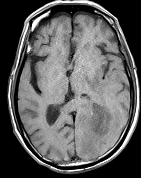 File:Brain abscess with dual rim sign (Radiopaedia 87566-103938 Axial T1 12).jpg