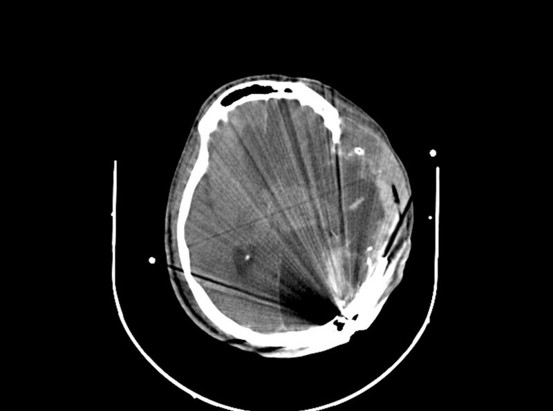 File:Brain injury by firearm projectile (Radiopaedia 82068-96087 B 106).jpg