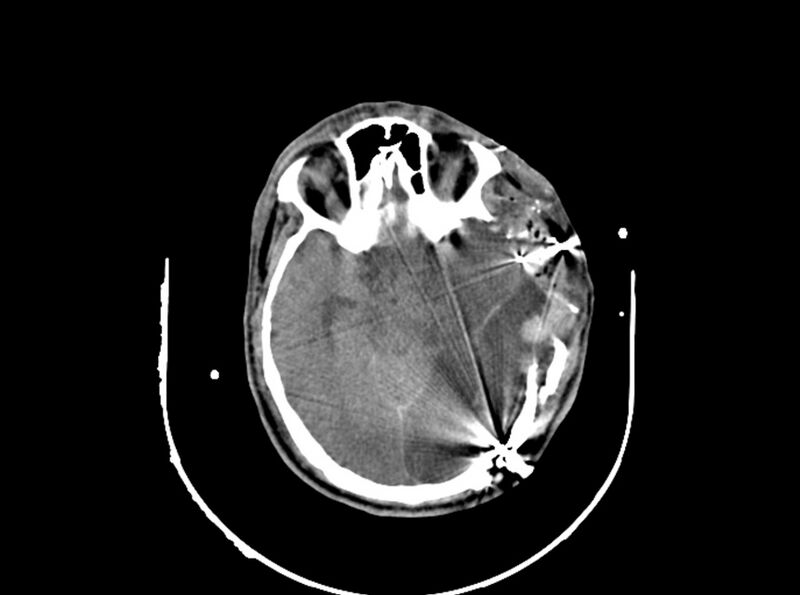 File:Brain injury by firearm projectile (Radiopaedia 82068-96087 B 90).jpg