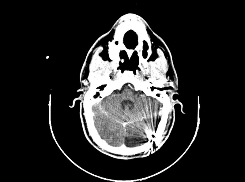 File:Brain injury by firearm projectile (Radiopaedia 82068-96088 B 86).jpg