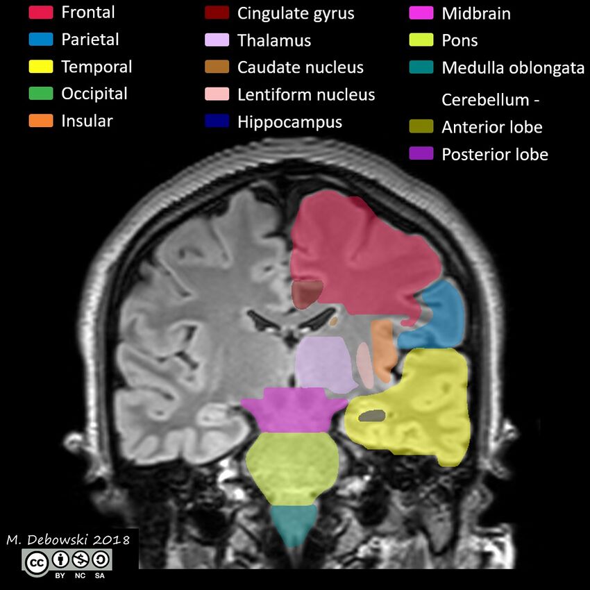 Brain lobes - annotated MRI (Radiopaedia 61691-69700 Coronal 39).JPG