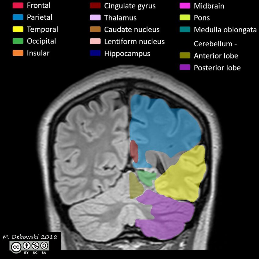 Brain lobes - annotated MRI (Radiopaedia 61691-69700 Coronal 54).JPG
