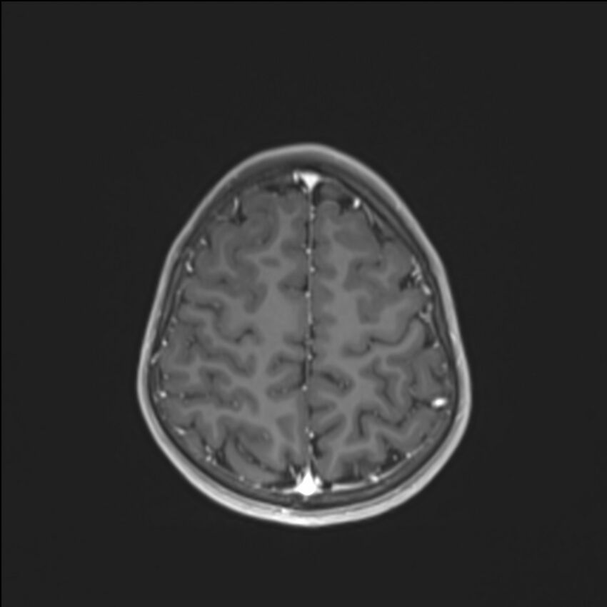Brainstem glioma (Radiopaedia 70548-80674 Axial T1 C+ 126).jpg