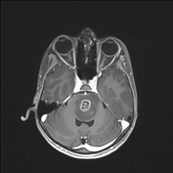 File:Brainstem glioma (Radiopaedia 70548-80674 Axial T1 C+ 51).jpg