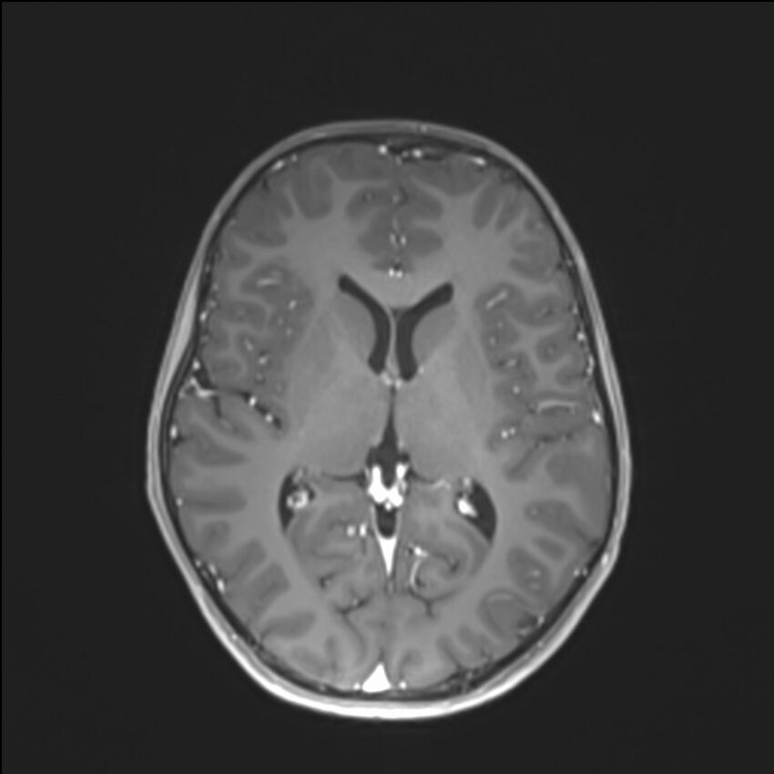 Brainstem glioma (Radiopaedia 70548-80674 Axial T1 C+ 87).jpg