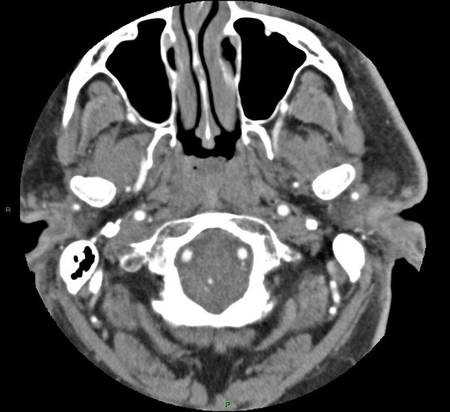 File:Brainstem hemorrhage (Radiopaedia 58794-66028 D 21).jpg