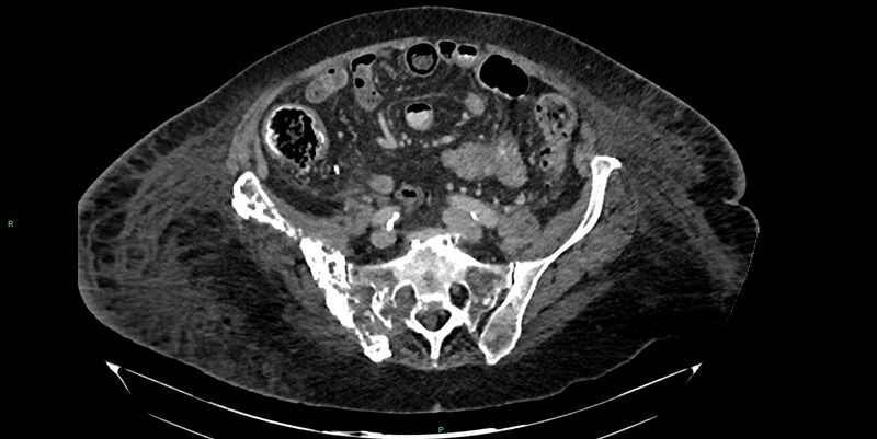 File:Breast cancer pelvic bony metastases (Radiopaedia 84470-99824 Axial bone window 28).jpg