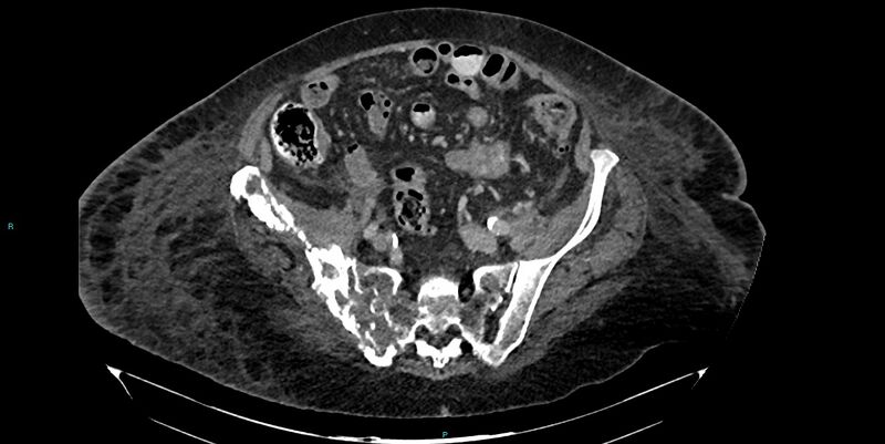File:Breast cancer pelvic bony metastases (Radiopaedia 84470-99824 Axial bone window 31).jpg