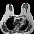 Breast carcinoma (multicentric multifocal in mammary Paget disease) (Radiopaedia 50966-56512 Axial T1 9).jpg