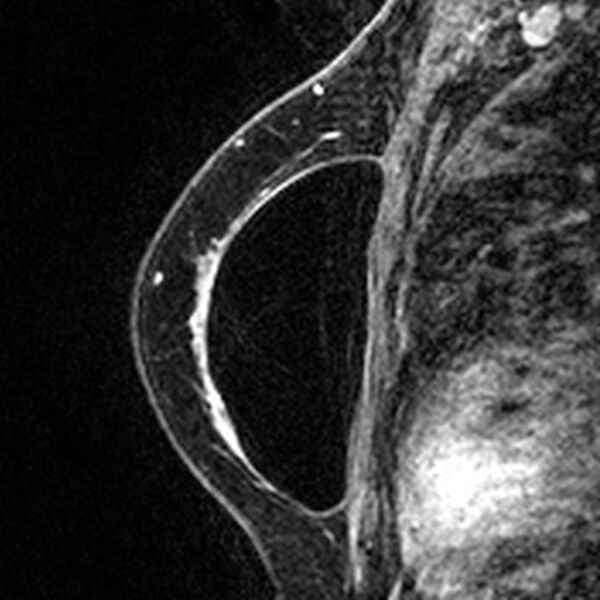 File:Breast implants - MRI (Radiopaedia 26864-27035 Sagittal T2 37).jpg