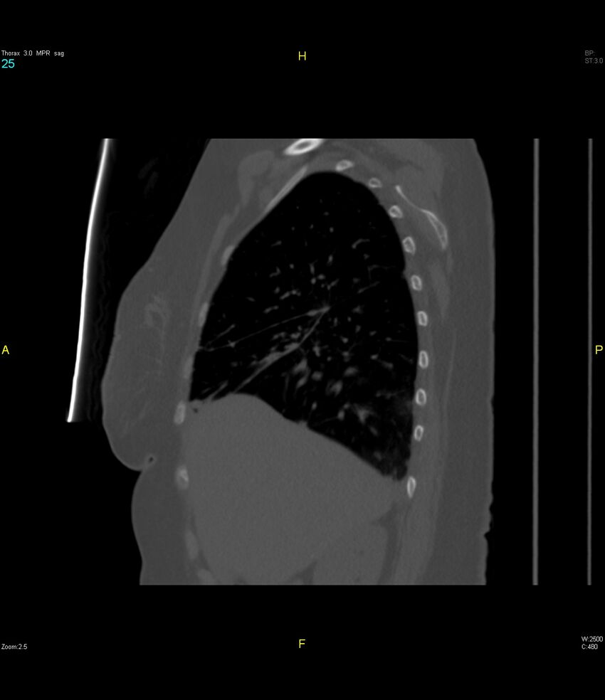 Breast primary with lung and bone metastases (Radiopaedia 40620-43228 Sagittal bone window 25).jpg
