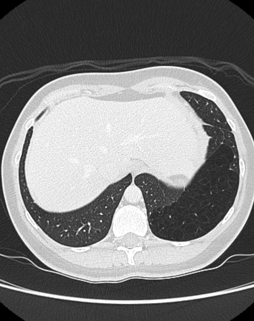 Bronchial atresia (Radiopaedia 50007-55297 Axial lung window 96).jpg