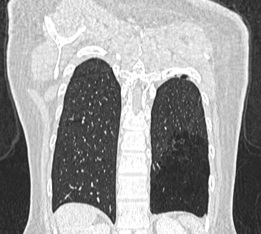 Bronchial atresia (Radiopaedia 50007-55297 Coronal lung window 100).jpg
