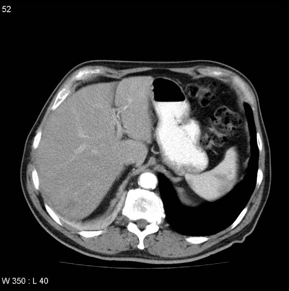 File:Bronchial carcinoid tumor with right lower lobe collapse (Radiopaedia 29060-29422 A 51).jpg