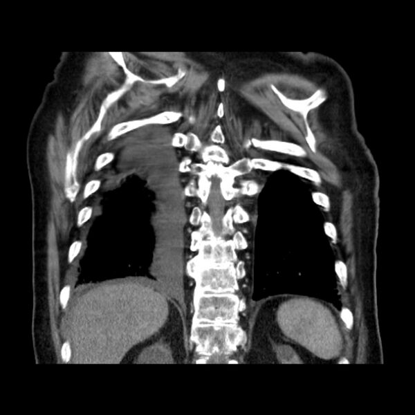File:Bronchogenic adenocarcinoma and pulmonary embolism (Radiopaedia 9097-9806 C 42).jpg