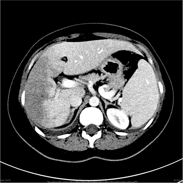 File:Budd-Chiari syndrome (Radiopaedia 27929-28177 Axial liver window 19).JPG