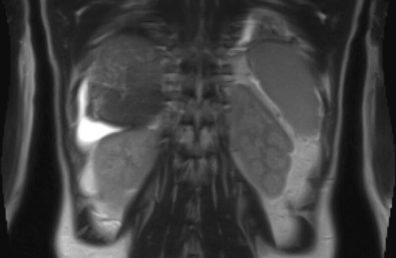 File:Budd Chiari syndrome (Radiopaedia 70299-80375 Coronal T2 26).jpg