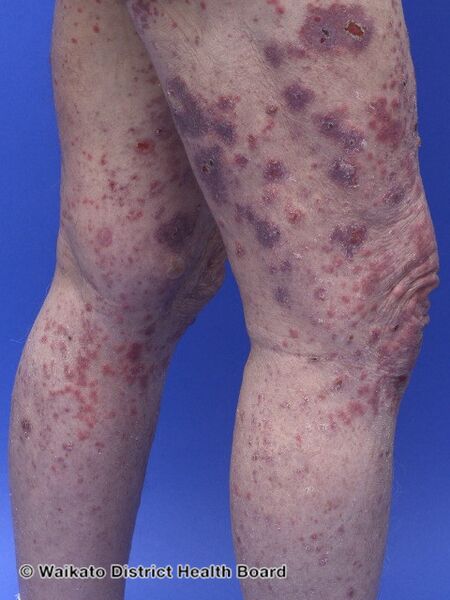File:Bullous pemphigoid induced by pembrolizumab (DermNet NZ pembrolizumab-pemphigoid-01).jpg