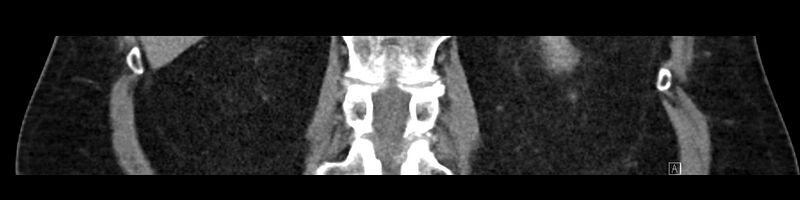 File:Buried bumper syndrome - gastrostomy tube (Radiopaedia 63843-72575 Coronal 58).jpg
