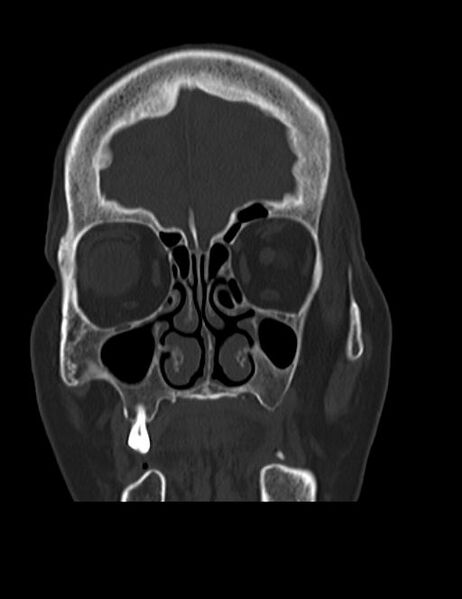File:Burnt-out meningioma (Radiopaedia 51557-57337 Coronal bone window 9).jpg