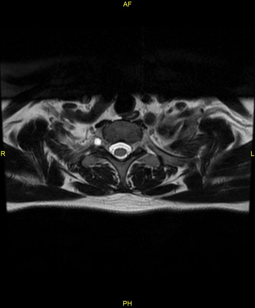 C5 nerve sheath tumor (Radiopaedia 85777-101596 Axial T2 84).jpg
