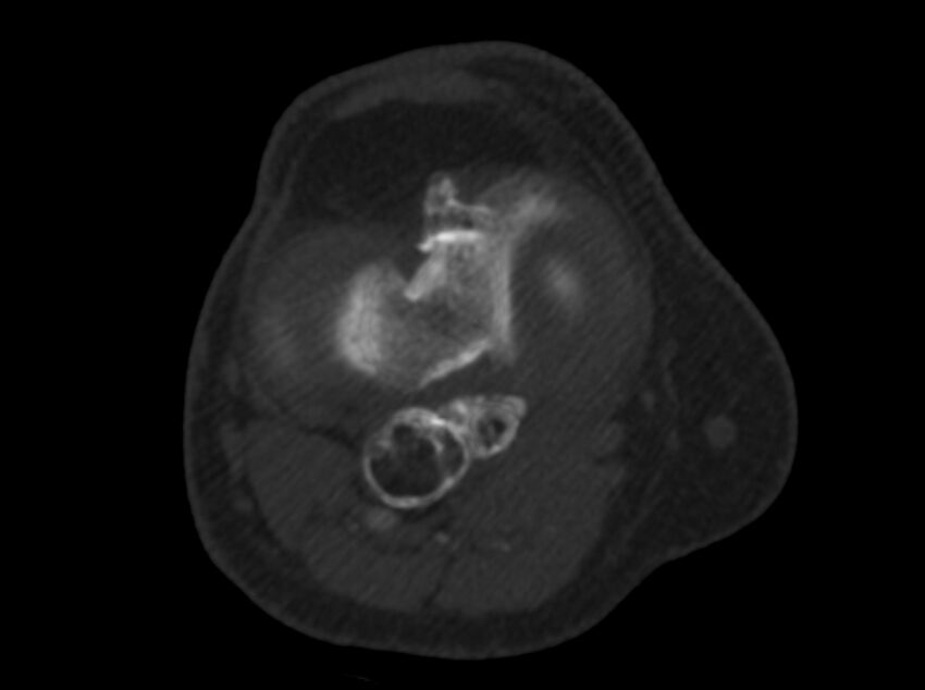 Calcified hematoma - popliteal fossa (Radiopaedia 63938-72763 C 27).jpg