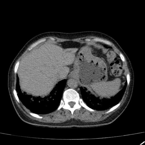File:Calcified hepatic hydatid cyst (Radiopaedia 26872-27046 Axial non-contrast 16).jpg