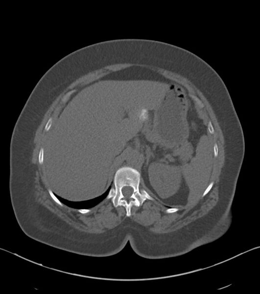 File:Calcified hepatic hydatid cyst (Radiopaedia 81127-94738 Axial non-contrast 25).jpg