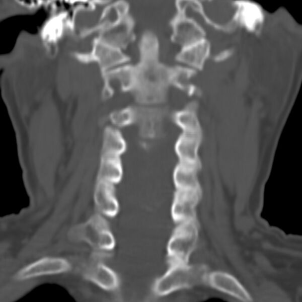 File:Calcified meningioma - cervical canal (Radiopaedia 70136-80171 Coronal bone window 9).jpg