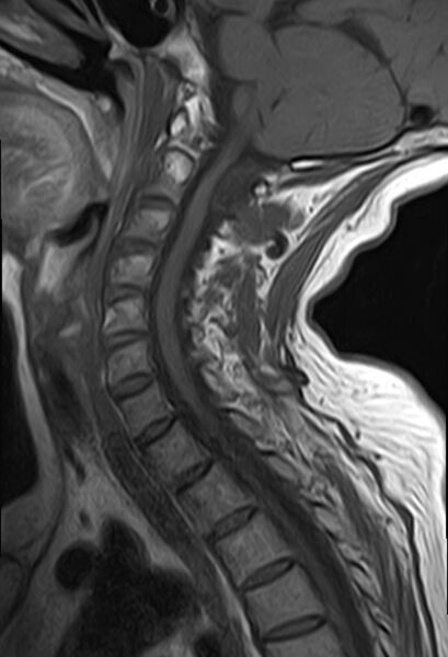 File:Calcified meningioma - cervical canal (Radiopaedia 70136-82468 Sagittal T1 9).jpg