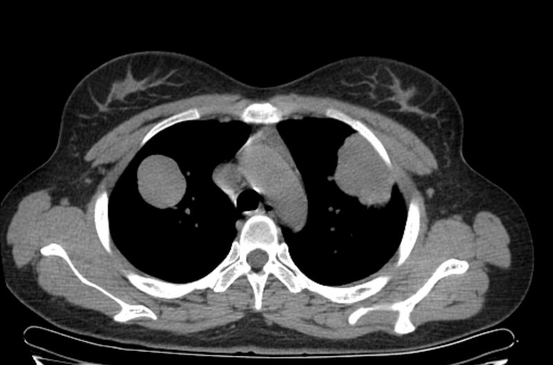 File:Cannonball metastases - uterine choriocarcinoma (Radiopaedia 70137-80173 Axial non-contrast 25).jpg