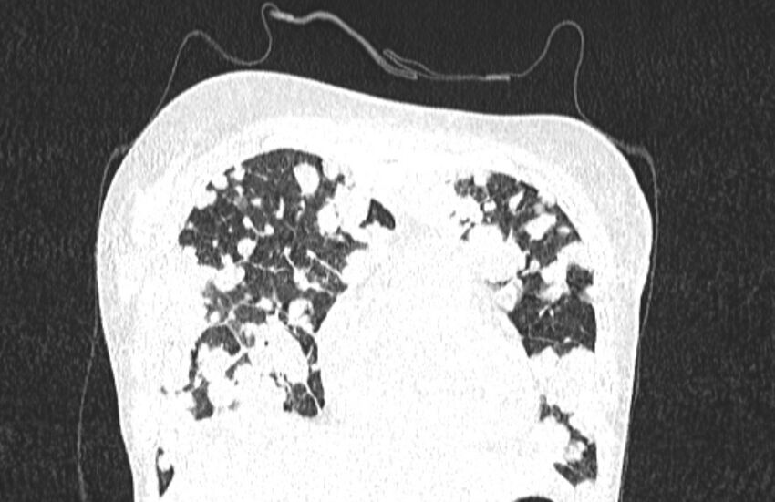 Cannonball metastases from breast cancer (Radiopaedia 91024-108569 Coronal lung window 33).jpg